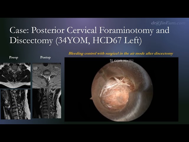 V-Sheath surgical demonstration 2