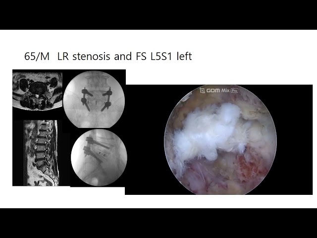UBE (Biportal Endoscope) EXTLIF