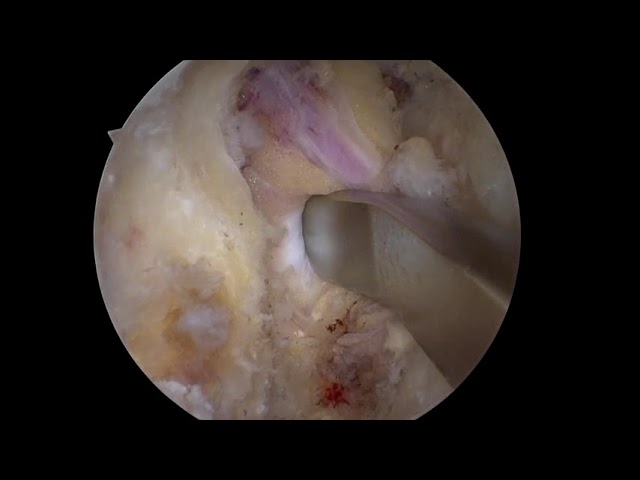Endoscopic Foraminal Stenosis L5/S1 Left