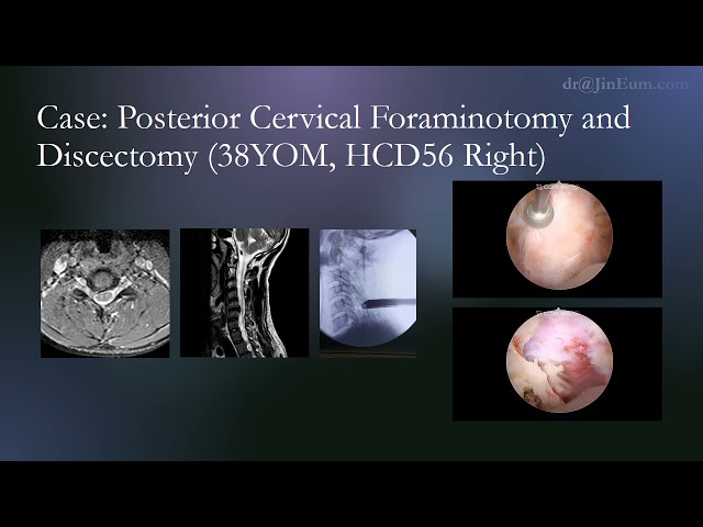 Uscope spine surgery: Cervical Modified FESS with standard instruments