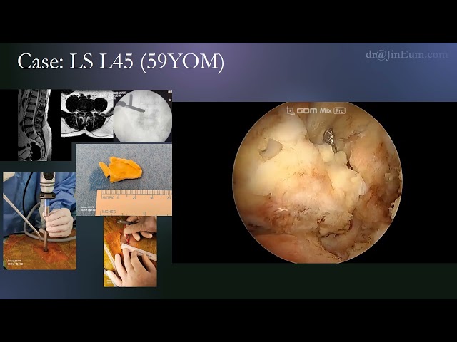 Uscope spine surgery: Lumbar modified FESS with standard instruments